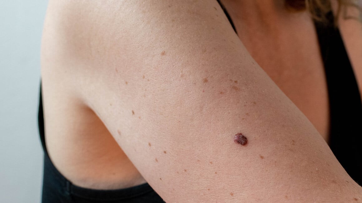 Broj oboljelih od melanoma i tumora kože u porastu
