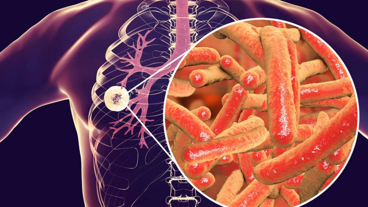 Sve manje oboljelih od tuberkuloze