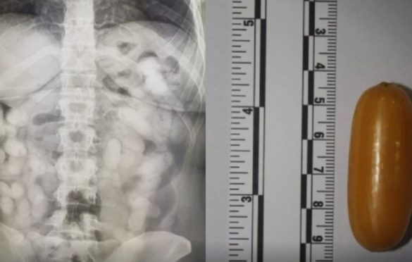 Brazilka uhapšena u Zagrebu “izbacila” kilogram kokaina iz tijela: Deset dana pila laksative